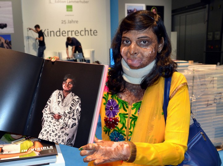Žena z Pakistanu po útoku kyselinou
